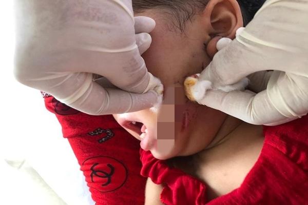 Chó&nbsp;dại tấn công cháu bé 19 tháng tuổi, gây thương tích nặng trên mặt-1