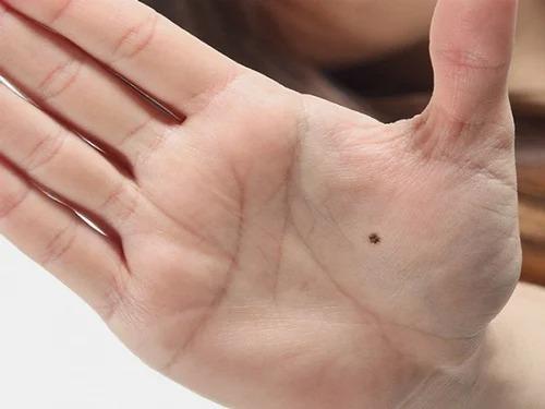4 nốt ruồi điềm báo cát tường, ai sở hữu thường giàu sang-1
