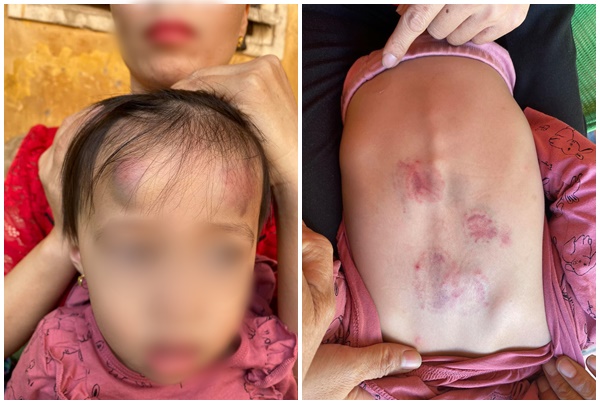 Bé gái 2 tuổi bị bạn học đánh, đạp dã man trong lớp học