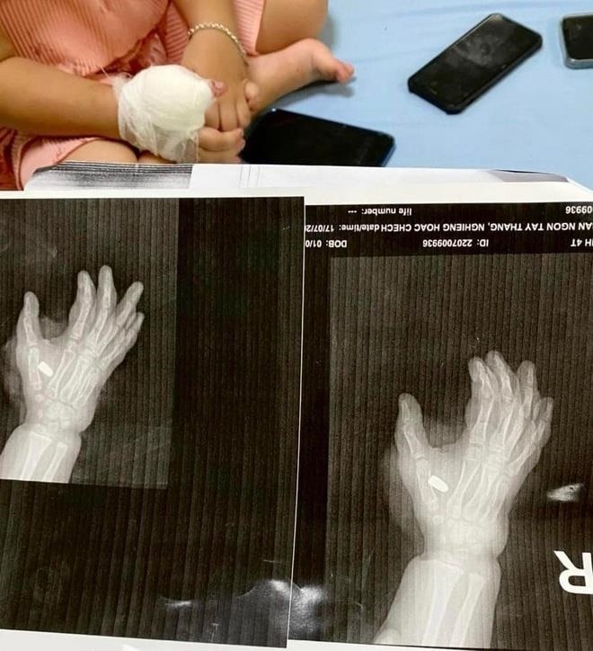 Hình ảnh viên đạn nằm trong tay của cháu bé 4 tuổi. Ảnh: Công an TP Thanh Hóa.