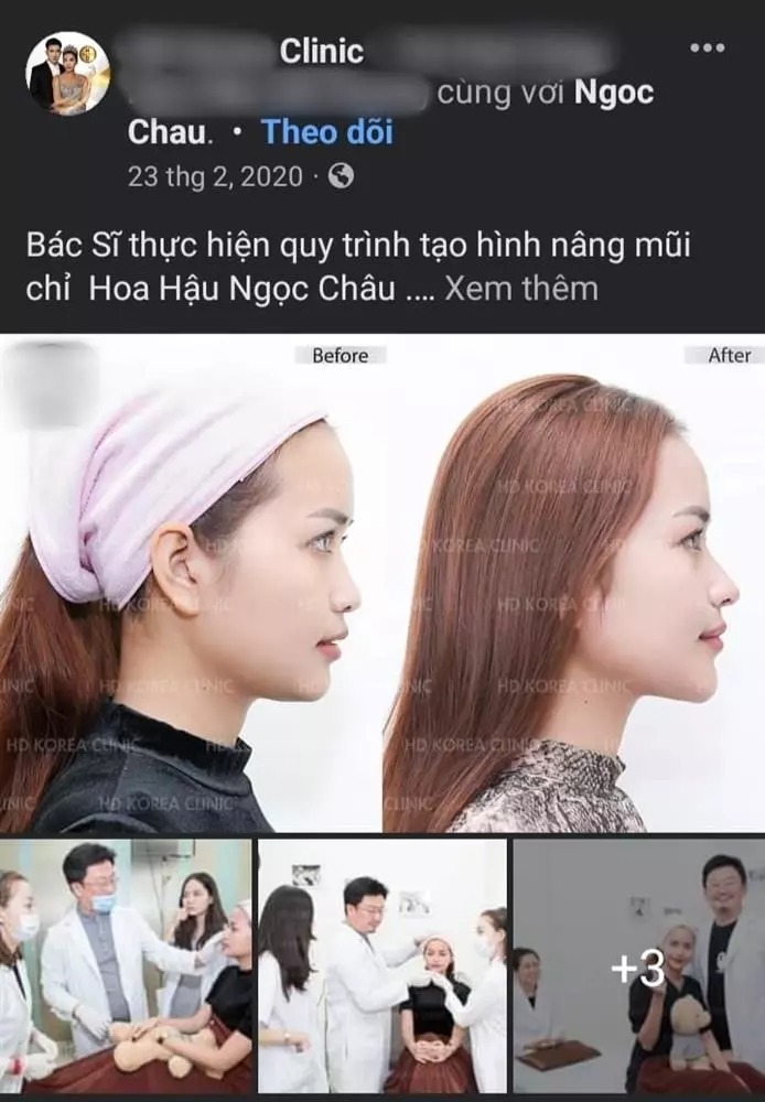 Những hình ảnh này thổi bùng cuộc tranh cãi cực căng giữa cộng đồng fan sắc đẹp Việt. Phe thì bảo vệ đương kim Hoa hậu Hoàn vũ Việt Nam và cho rằng những hình ảnh này đều là từ thời Ngọc Châu chuẩn bị sang Ba Lan thi Miss Supranational và thẩm mỹ nội khoa không phải can thiệp xâm lấn bằng dao kéo (phẫu thuật) nên không sai.