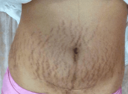 vợ chồng, rạn da, giảm cân, cô dâu bị rạn da trên bụng