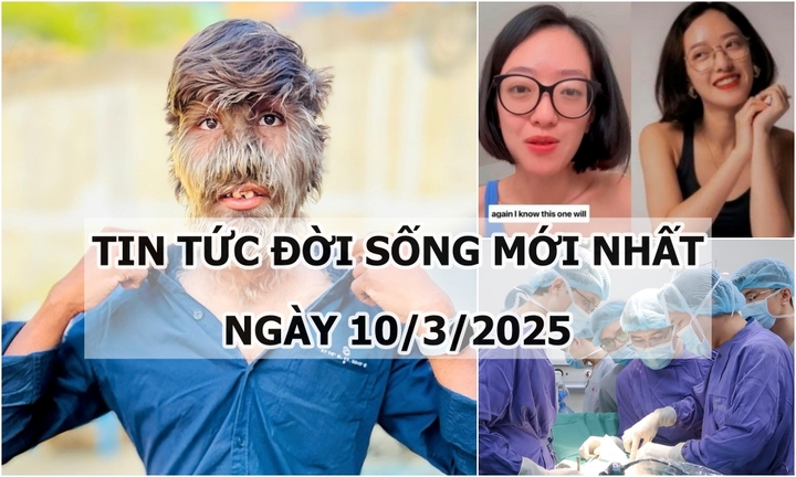 Tin tức đời sống 10/3: Hội chứng cực hiếm khiến mặt chàng trai mọc đầy lông