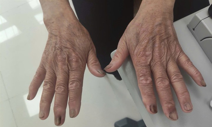 Dụi mắt bằng tay bẩn, người phụ nữ 63 tuổi suýt mất thị lực