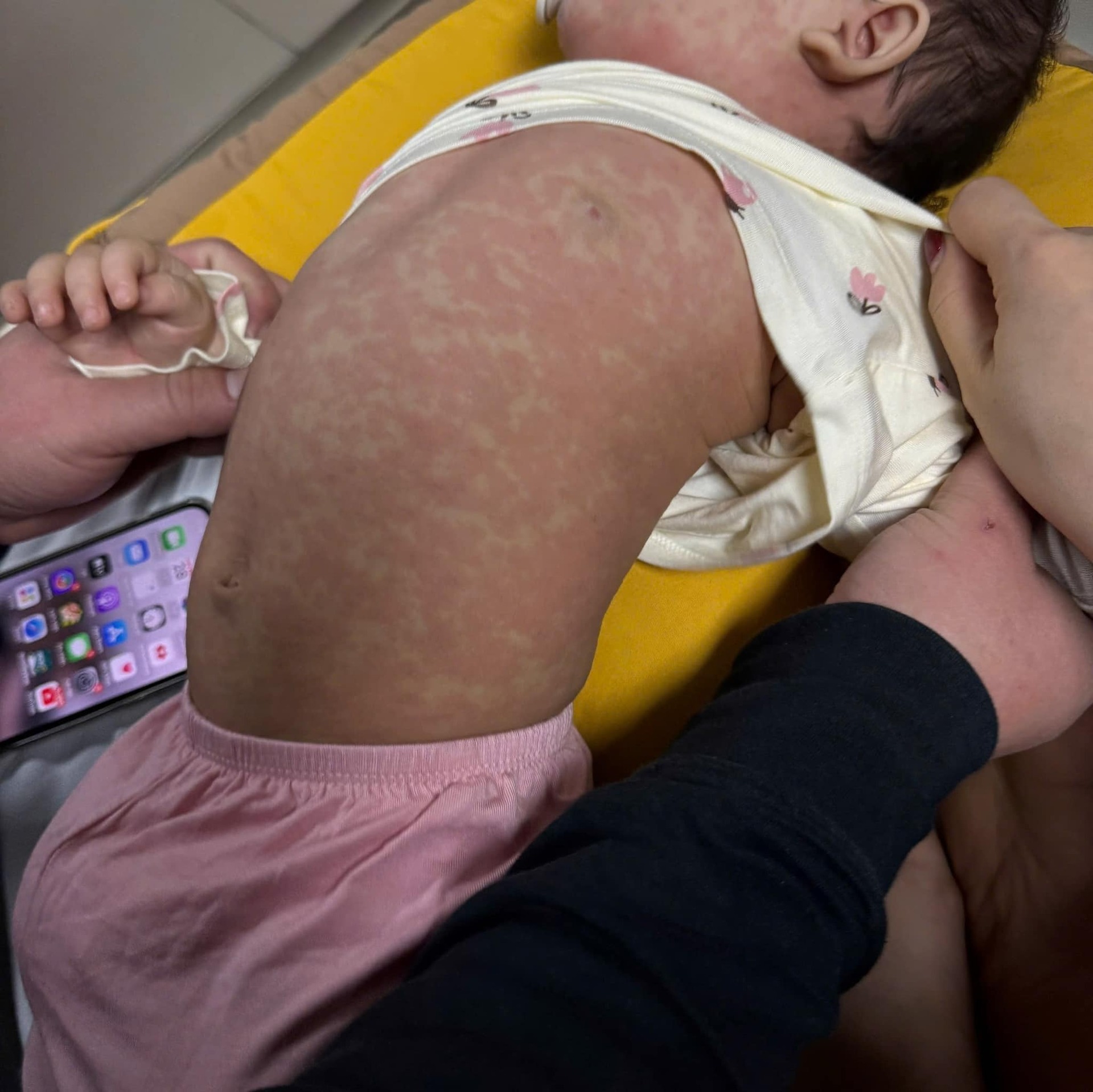 Hà Nội: Dịch Sởi vẫn tăng mạnh, lượng trẻ tiêm vắc xin tăng đột biến - 8