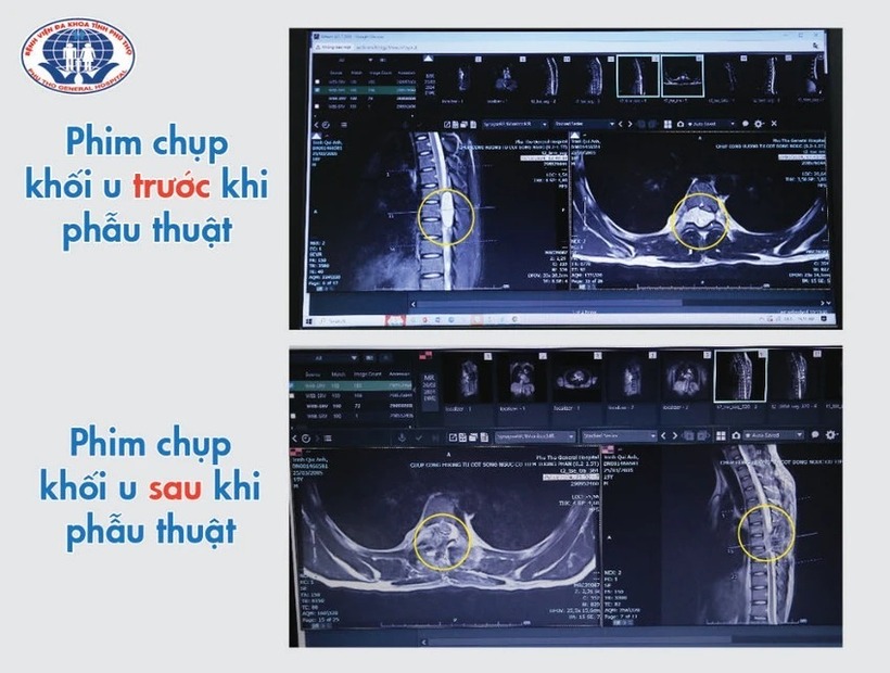 Phim chụp khối u trước và sau khi phẫu thuật. Ảnh: Pháp Luật TP.HCM