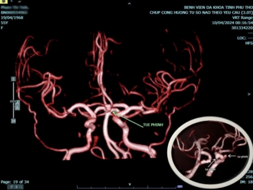 Máy chụp cộng hưởng tử cho thấy hình ảnh túi phình mạch máu não. Ảnh: VietNamNet