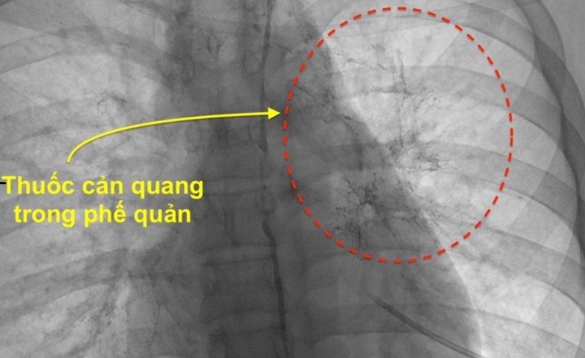 Bệnh nhân được chẩn đoán bị viêm phế quản “nhựa” thể hiếm gặp và tràn dịch dưỡng chấp màng tim. Ảnh: Tri Thức