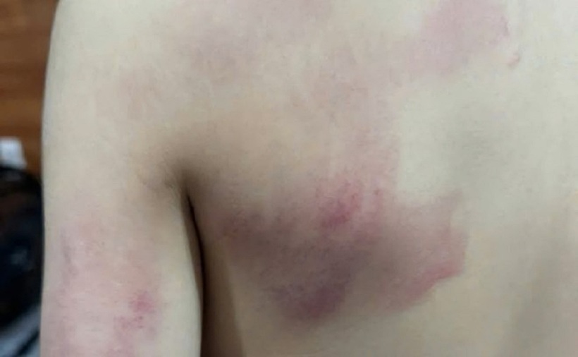 Vết bầm tím trên người học sinh lớp 1. Ảnh: Lao động