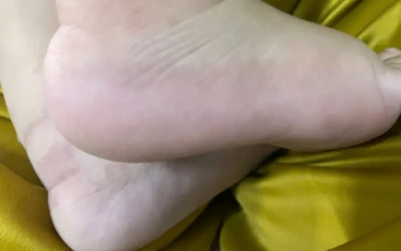 Bé trai bị phù chân trước khi điều trị. Ảnh: VTV Times