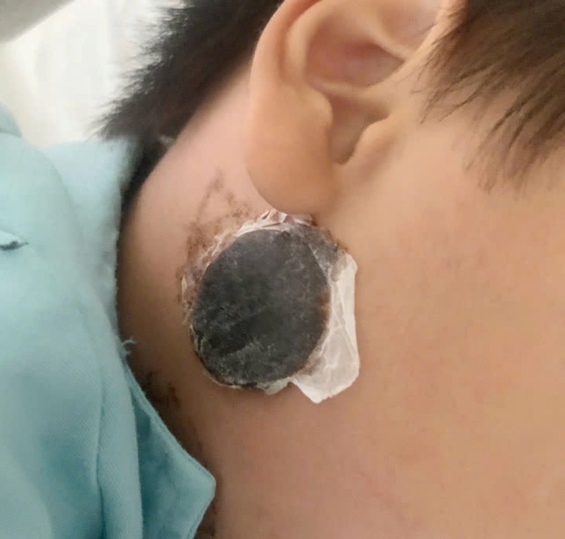 Hiện trẻ đang được theo dõi và điều trị theo phác đồ tại bệnh viện. Ảnh: BVCC.