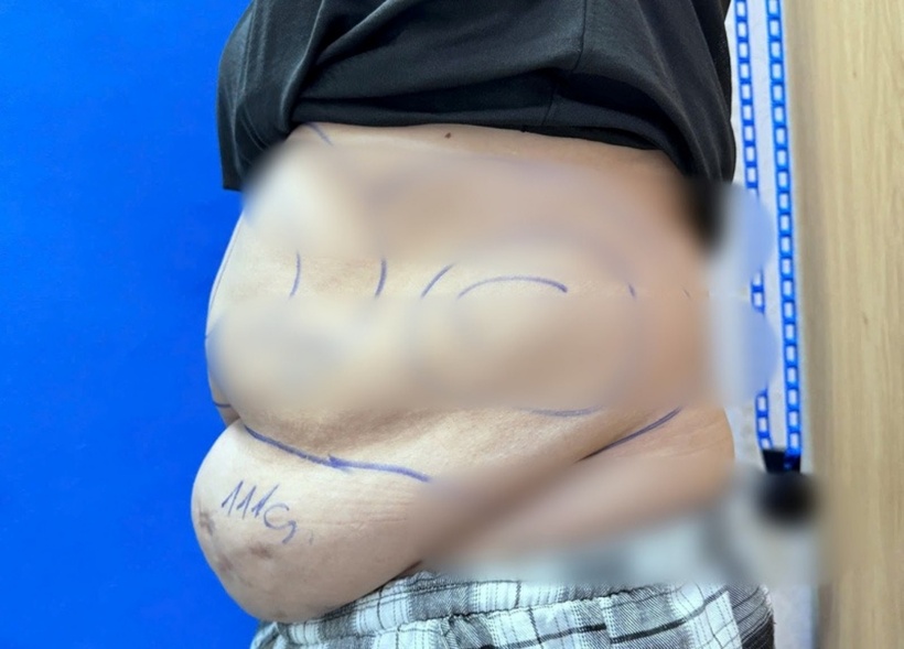 Thời điểm nhập viện người phụ nữ trong tình trạng bụng béo nhiều mỡ, nhiều vết sẹo cũ. Ảnh: Tuổi Trẻ