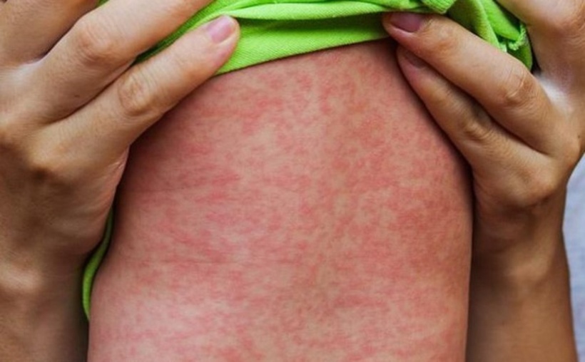 Phát ban sởi xuất hiện khoảng 6 ngày rồi lặn.