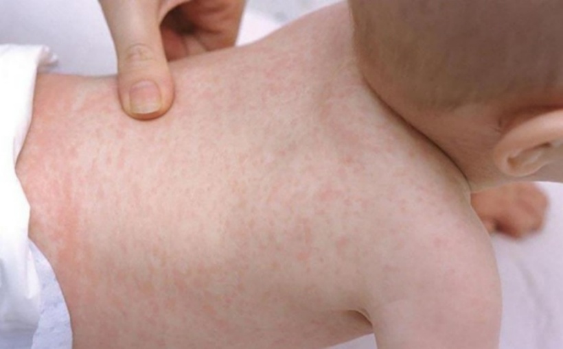 Bệnh sởi có thể xuất hiện quanh năm.