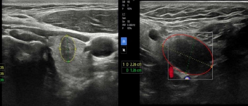 Hình ảnh siêu âm phát hiện nhân thùy trái (khoanh vàng) và hạch vùng cổ bên phải (khoanh đỏ). Ảnh: Gia Đình Việt Nam