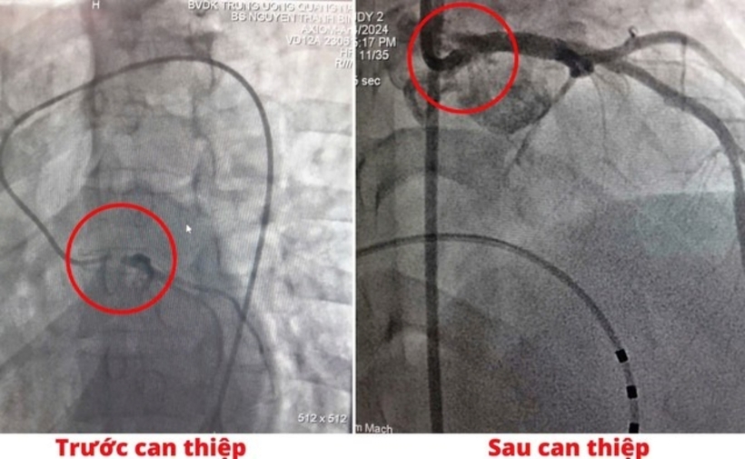 Hình ảnh chụp DSA bệnh nhân tắc thân chung động mạch vành trái và sau can thiệp đã tái thông mạch vành trái. Ảnh: Sức Khỏe & Đời Sống