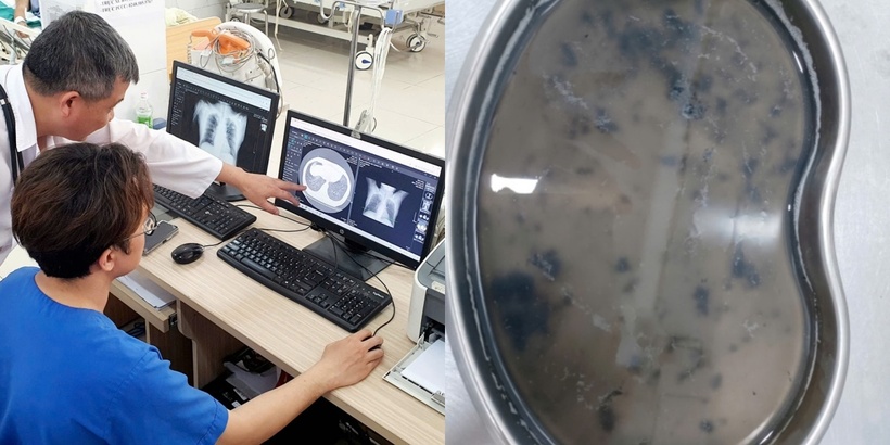Hình ảnh phổi của các nạn nhân vụ phóng hoả bị tổn thương do khí và muội than và kết quả rửa phổi, phế nang của các nạn nhân