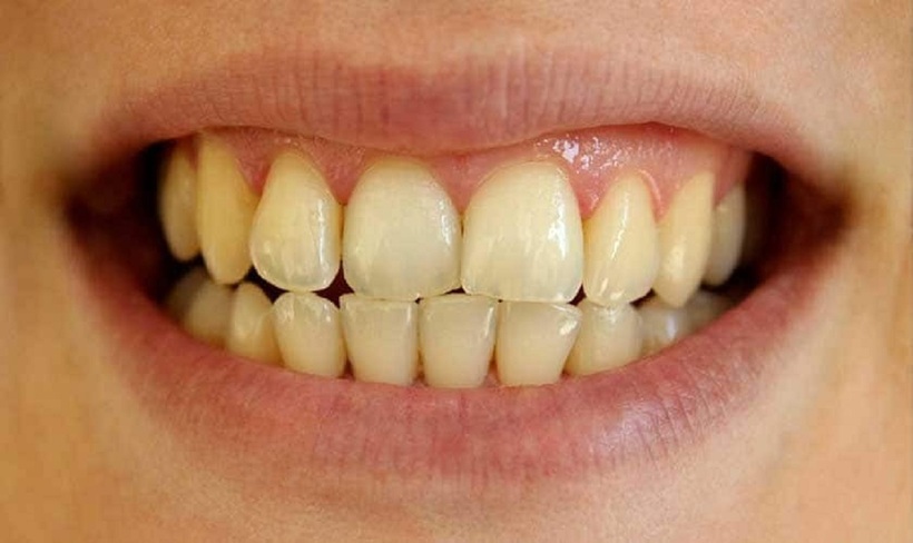 Răng ố vàng là một vấn đề thường gặp, không chỉ ảnh hưởng đến thẩm mỹ mà còn có thể là dấu hiệu của sự suy giảm sức khỏe răng miệng.