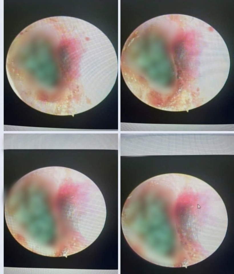 Hình ảnh tổn thương thành ống tai của bệnh nhân sau khi ngoáy tai bằng tăm bông. Ảnh: Gia Đình & Xã Hội