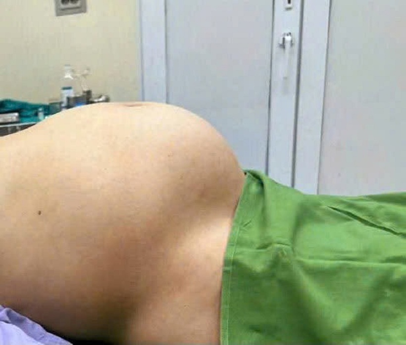 Bụng nữ bệnh nhân lớn như có bầu 8 tháng. Ảnh: Bệnh viện Việt Nam - Thuỵ Điển Uông Bí