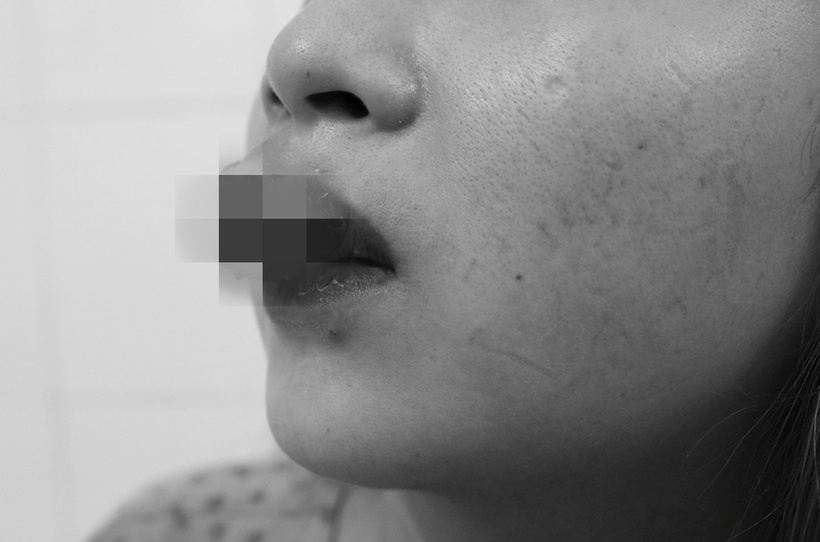 Một trường hợp biến chứng sau xăm môi. Ảnh: Vnexpress