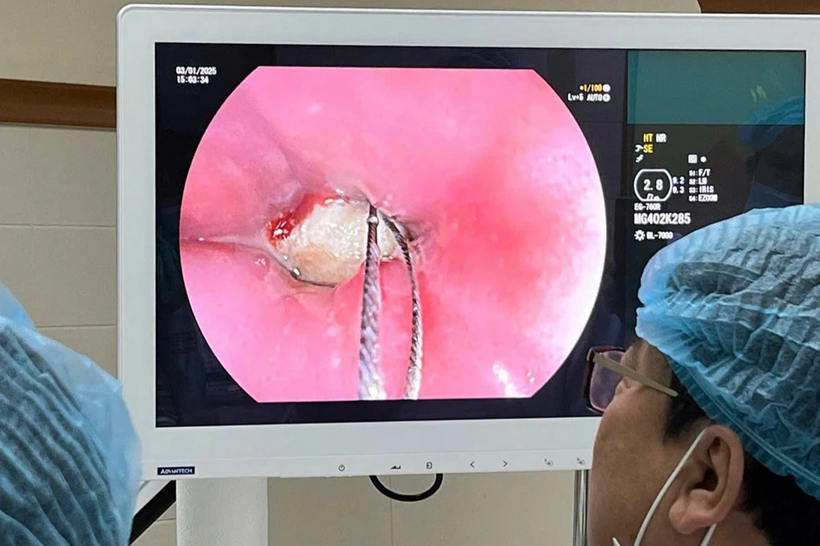 Mẩu xương lợn trong thực quản của bệnh nhân. Ảnh: Dân Trí