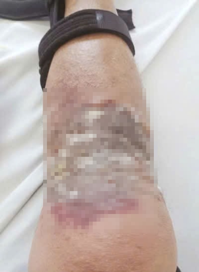 Người đàn ông bị nhiễm trùng da do bôi dầu nóng để chữa gãy xương. Ảnh: Sức Khỏe & Đời Sống