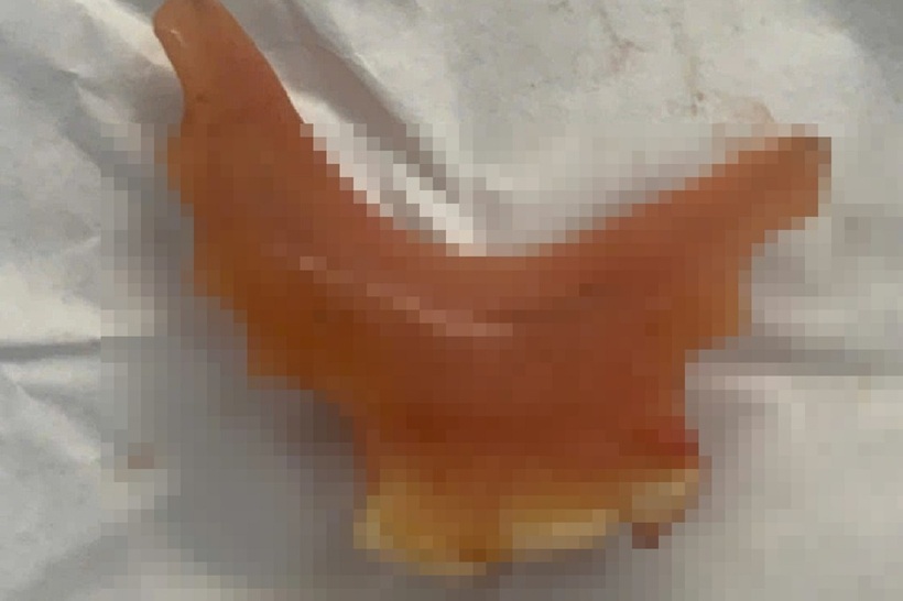 Hàm răng giả được bác sĩ lấy ra từ thực quản bệnh nhân. Ảnh: Dân trí