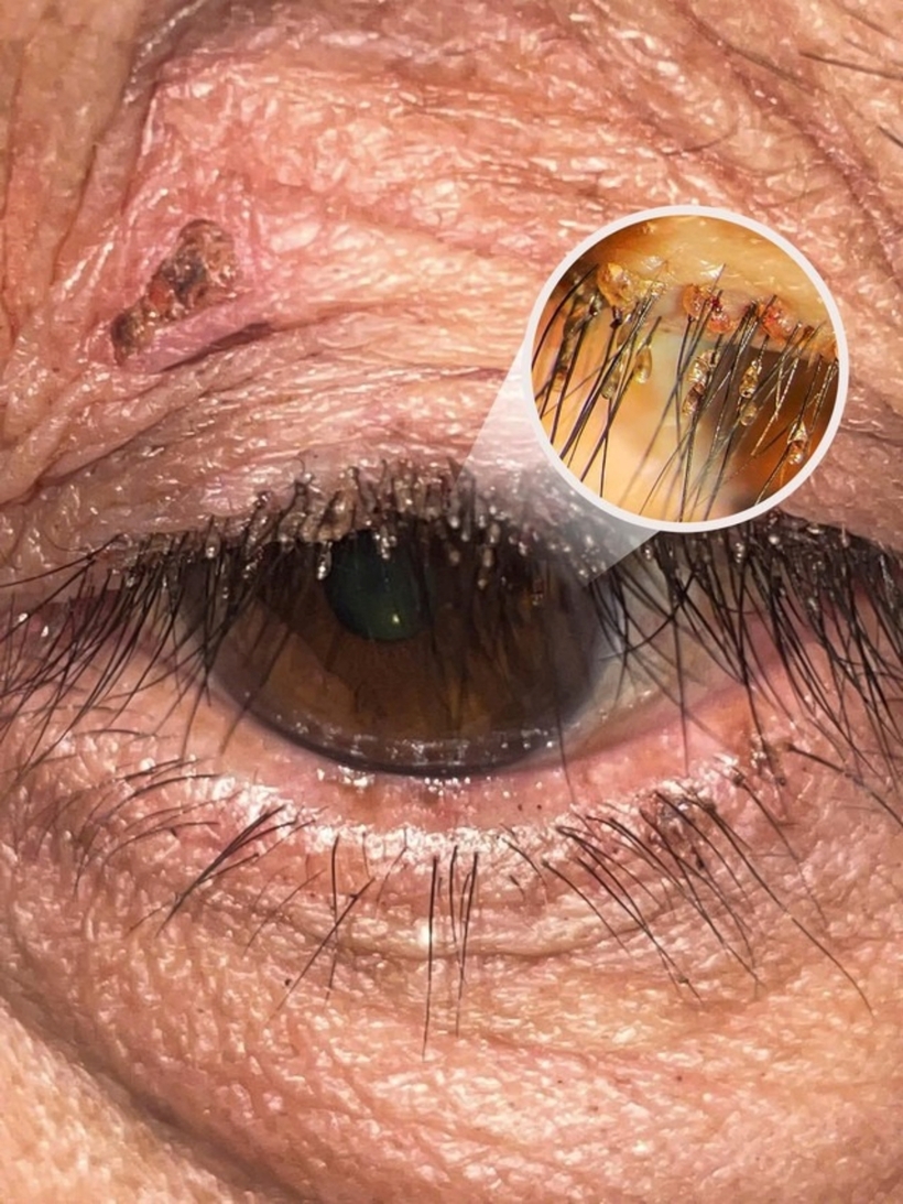 Hình ảnh rận mu kí sinh, làm tổ chi chít trên mi mắt nam bệnh nhân. Ảnh: Người Lao Động