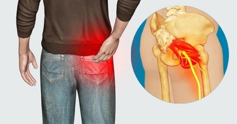 Thoát vị đĩa đệm L3-L4 chèn ép rễ dây thần kinh gây đau từ mông xuống chân (Ảnh minh họa)