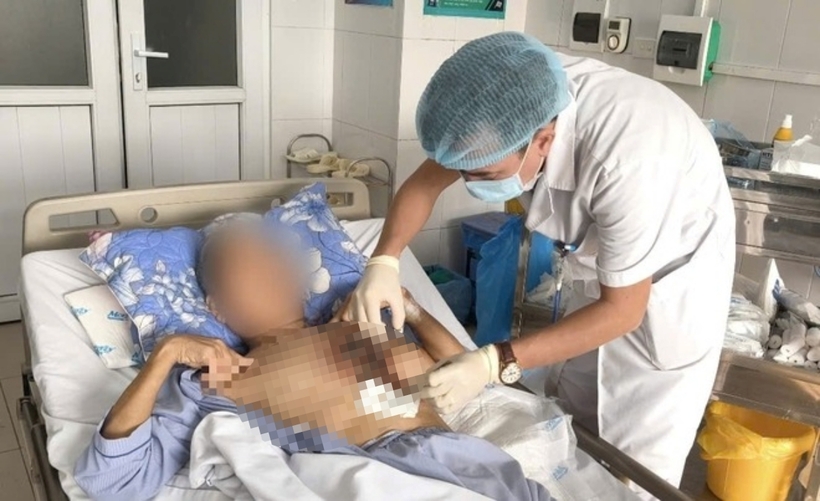 Nam bệnh nhân mắc nấm hiếm gặp bị hoại tử mô cơ vùng ngực trái. Ảnh: Sức Khỏe & Đời Sống