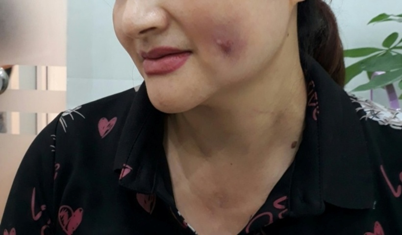 Phẫu thuật má lúm đồng tiền tiềm ẩn rủi ro bị nhiễm trùng rất lớn. Ảnh: Người đưa tin.