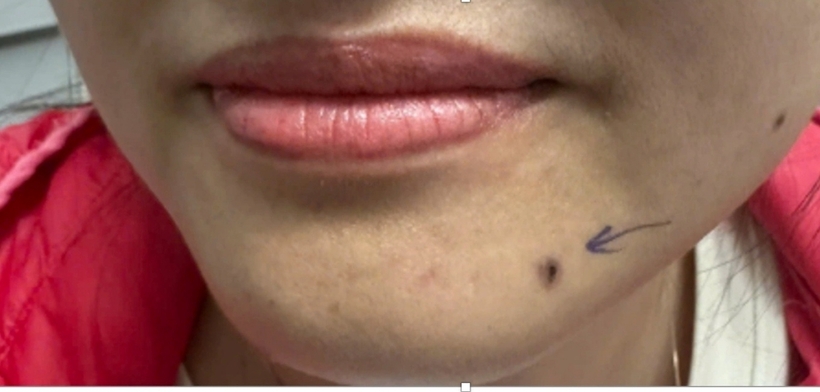 Hình ảnh nốt đen ở cằm của người bệnh. Ảnh: Dân Trí