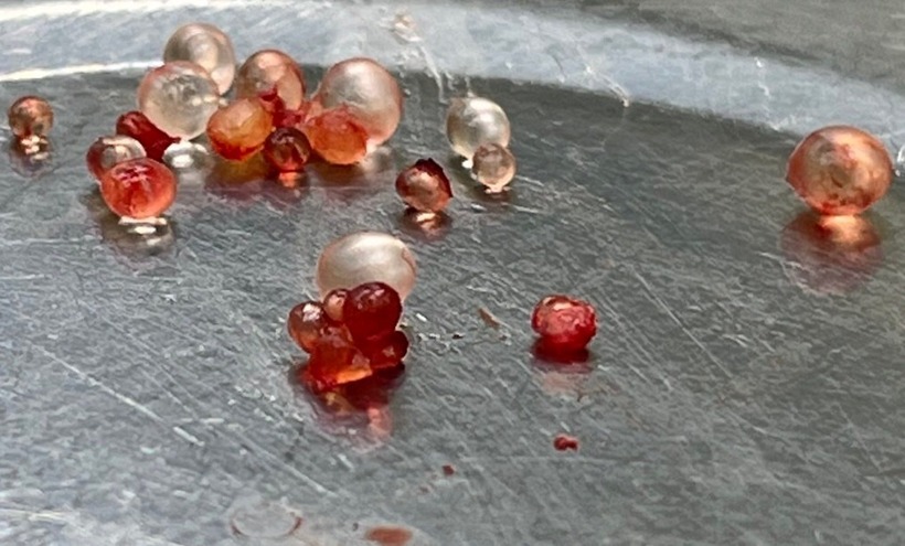 Silicon được lấy ra khỏi bàn tay người bệnh. Ảnh: Sở Y tế TP.Cần Thơ