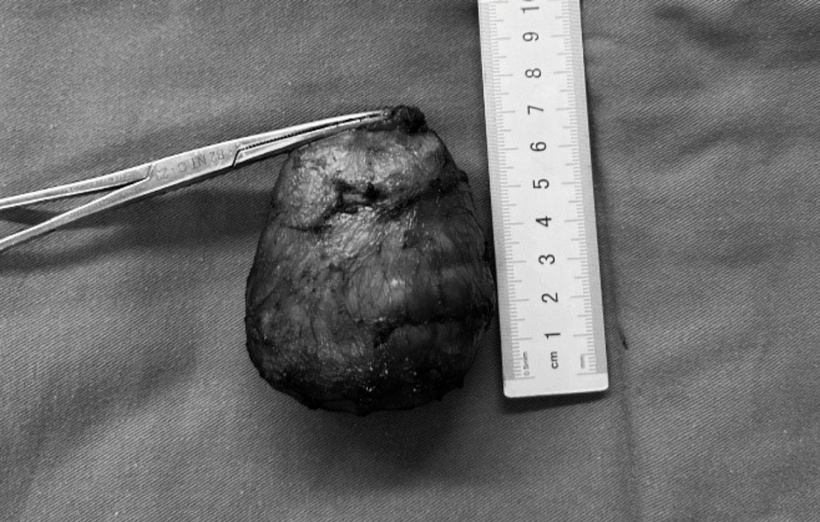 Khối u khoảng 7cm được phẫu thuật cắt bỏ. Ảnh: BVCC