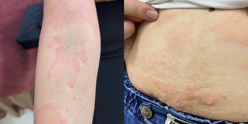 Hình ảnh dị ứng, nổi mày đay từ việc sử dụng nhiều thực phẩm lạ ngày Tết. Ảnh: BSCC