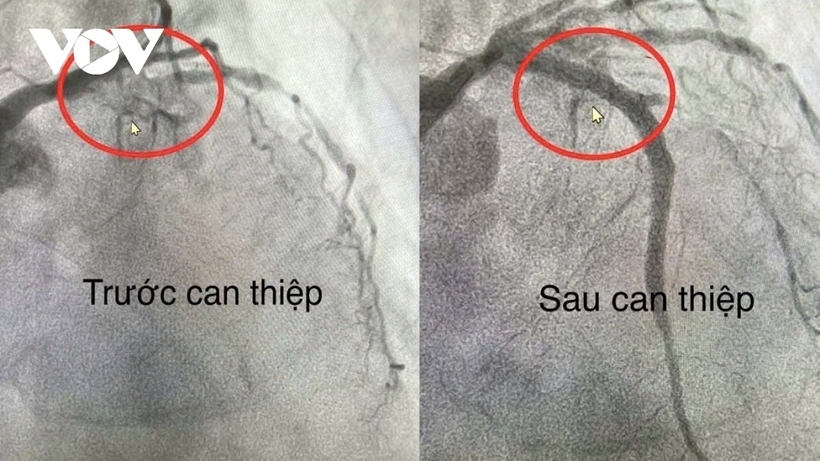 Hình ảnh trước và sau khi can thiệp. Ảnh: VOV