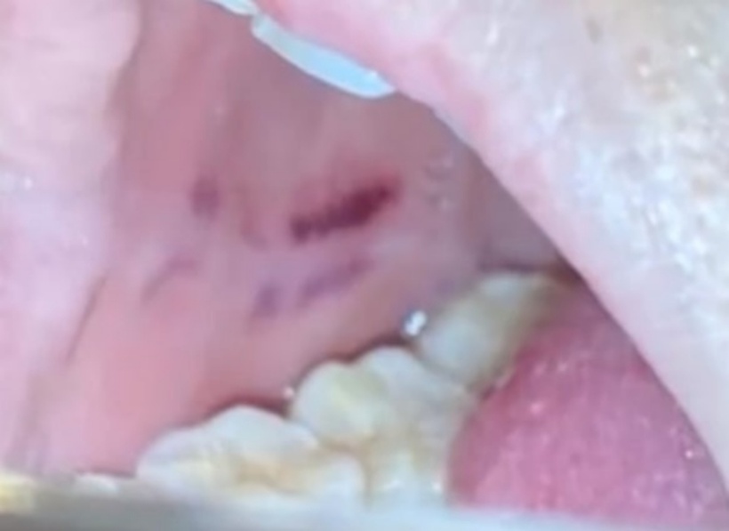 Sau khi ăn nhầm pháo cô thấy miệng bị tê, bên trong có vết xước. Ảnh: MSN.