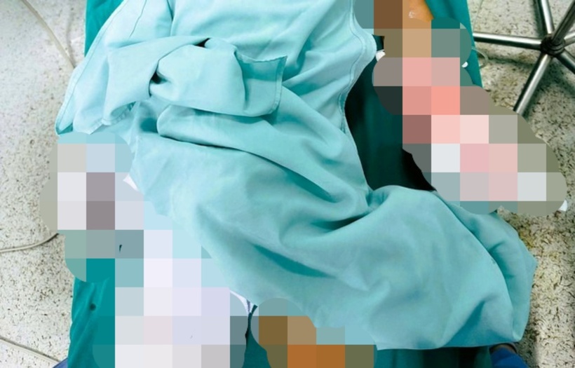 Cánh tay của nạn nhân bị pháo nổ gây dập nát, buộc các bác sĩ Bệnh viện Nhi tỉnh Thanh Hóa phải cắt bỏ và tạo mỏ vịt do tổn thương quá nặng, không thể phục hồi. Ảnh: Người Lao Động.