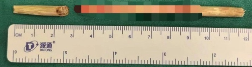 Chiếc que trẻ dài 11cm trong cơ thể cậu bé. Ảnh: Jam Press.