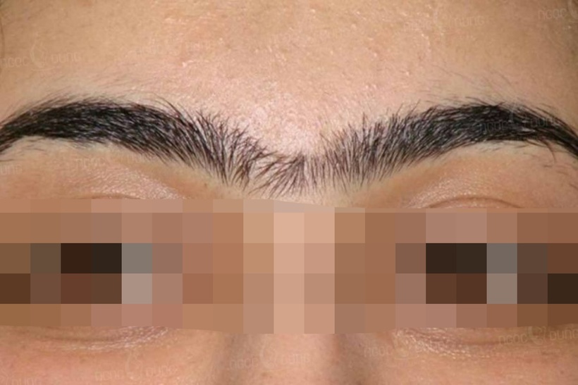 Chàng trai tin lời thầy tướng số, đi "khai mở" lông mày để giải hạn sao Thái Tuế, cuối cùng phải nhập viện cấp cứu. Ảnh minh họa.