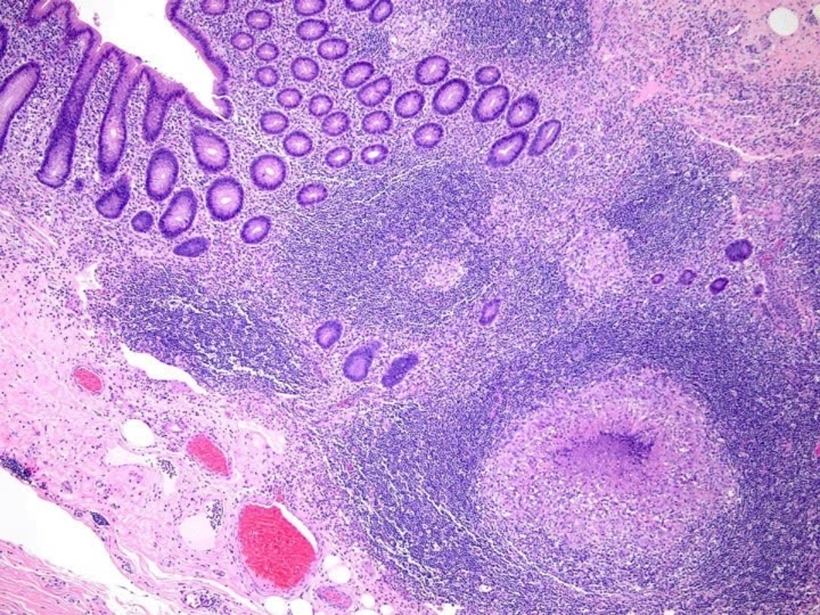 Hình ảnh tổn thương viêm do lao trên xét nghiệm mô bệnh học. Ảnh: Bảo Vệ Pháp Luật