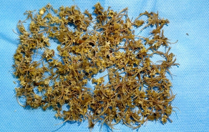 Các bác sĩ đã gắp ra được hàng nghìn mảnh xương rắn nhỏ, có chiều dài từ 3 mm đến 2 cm. Ảnh: Công An Nhân Dân