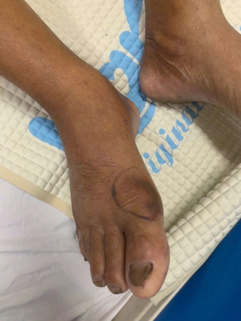 Cụ ông bị rắn hổ đất cắn vào tay và chân. Ảnh: VOV