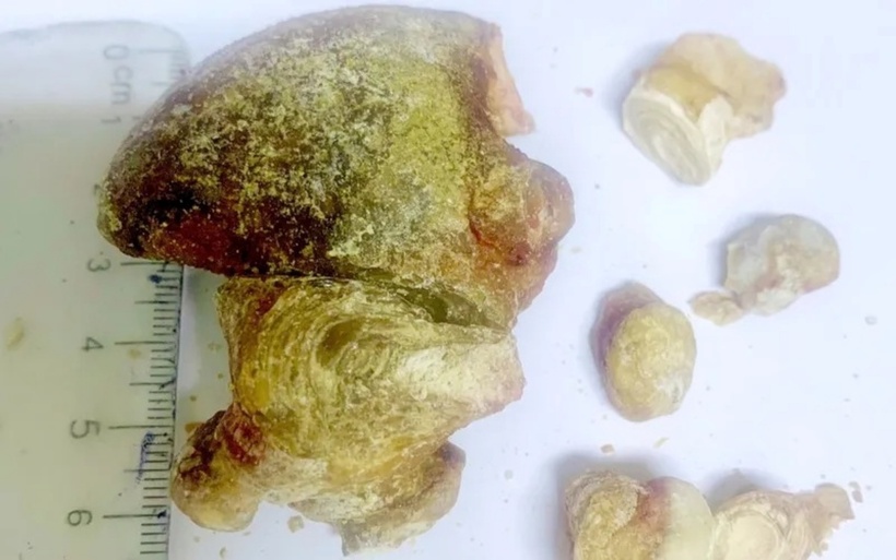 Khối sỏi san hô lớn được các bác sĩ lấy ra ngoài. Ảnh: Thời báo VTV