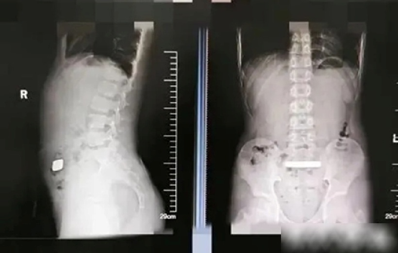 Bác sĩ phát hiện một vật kim loại rất đặc mắc kẹt trong đường tiêu hóa của bệnh nhi. Ảnh: QQ.