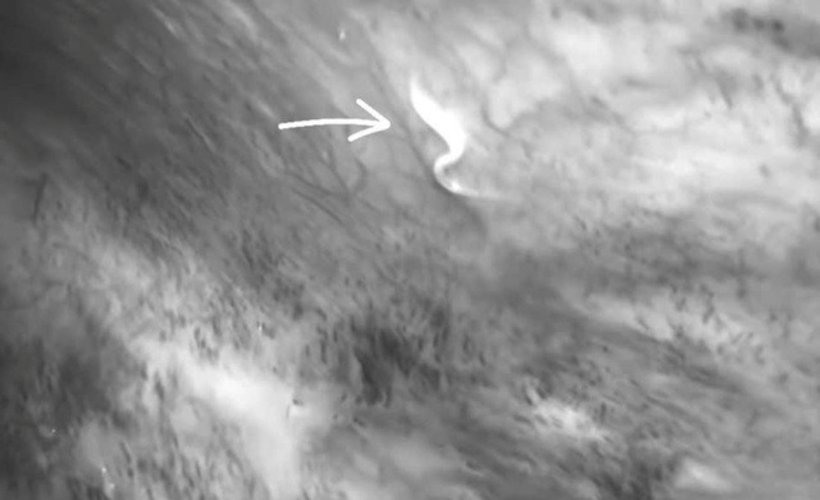 Hình ảnh giun ký sinh trong cơ thể bệnh nhân. Ảnh: Sức Khỏe & Đời Sống