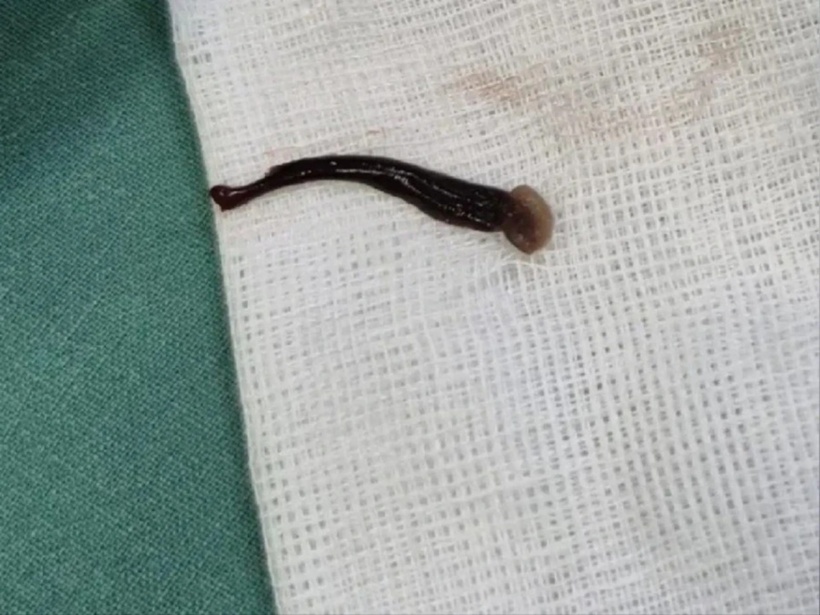 Con vắt được lấy ra ngoài. Ảnh: Nation Thailand