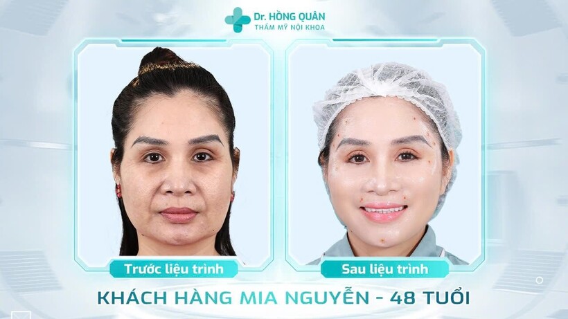 Hầu hết khách hàng được bác sĩ Quân thăm khám và điều trị đều cảm thấy hài lòng về kết quả thẩm mỹ,&nbsp; sự tận tâm và chuyên nghiệp trong từng quy trình.
