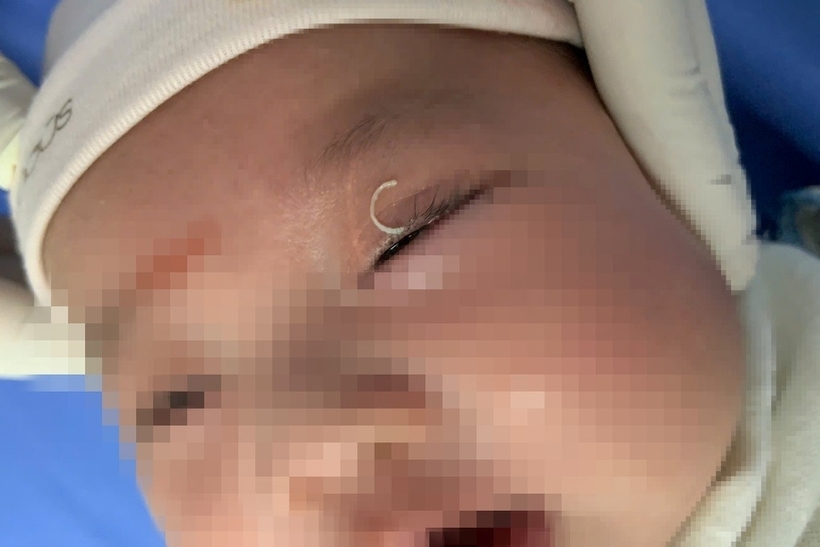 Bé trai 2 tháng tuổi được phát hiện, lấy ra dị vật là chiếc móng tay trong mắt. Ảnh: Dân trí